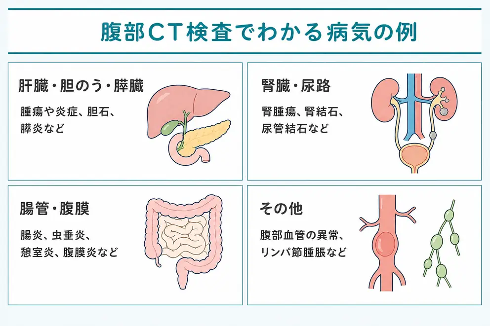 腹部CTでわかる病気は肝胆膵・腎尿路・消化管などに及ぶ