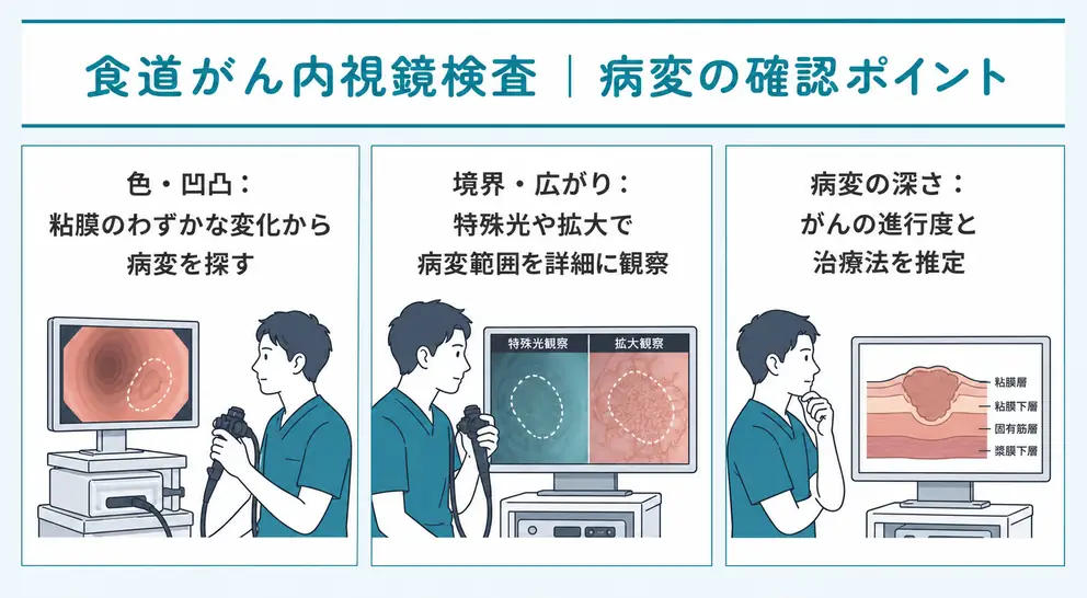 食道がんの内視鏡検査では色や凹凸だけでなく病変の広がりも確認する