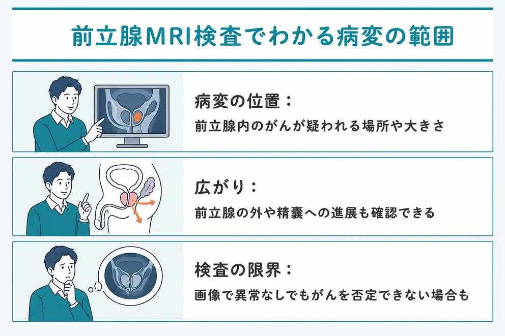 前立腺MRI検査では病変の位置と周囲への広がりを確認できる